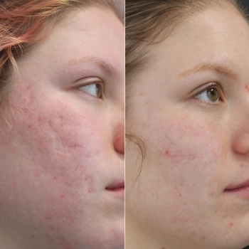 acne & acne scarring