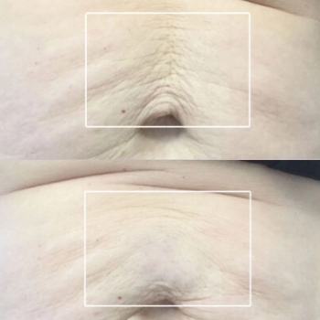 acne & acne scarring