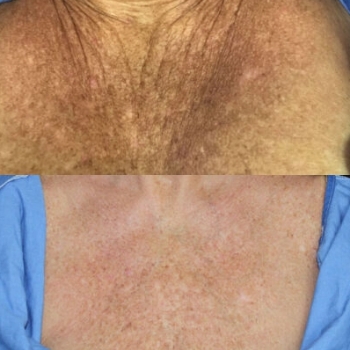 acne & acne scarring