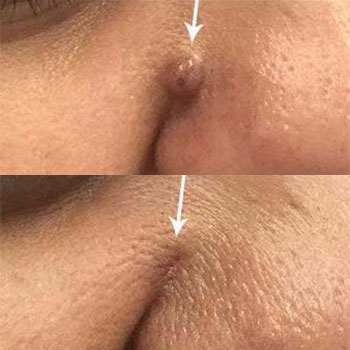 acne & acne scarring