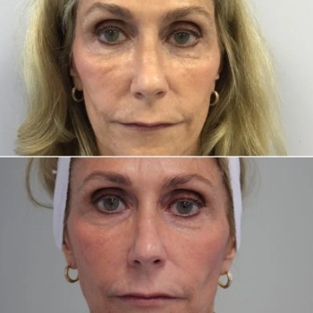 acne & acne scarring