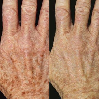 acne & acne scarring