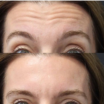 acne & acne scarring