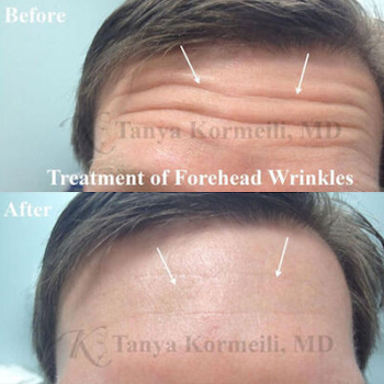 acne & acne scarring