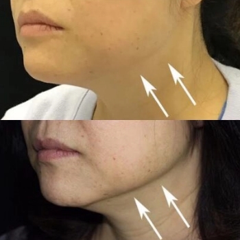 acne & acne scarring