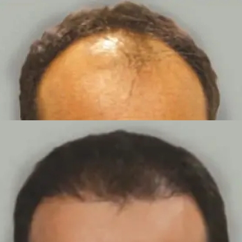acne & acne scarring
