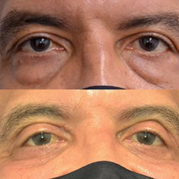 acne & acne scarring