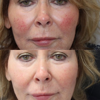 acne & acne scarring