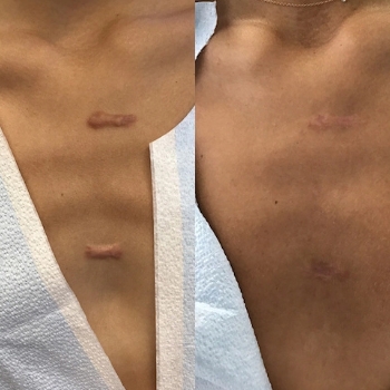 acne & acne scarring