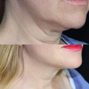 acne & acne scarring