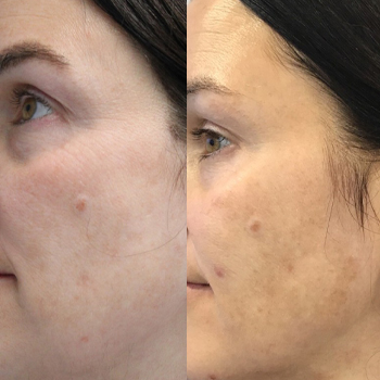 acne & acne scarring