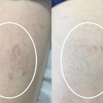 acne & acne scarring