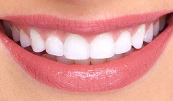 Gummy Smile Correction Los Angeles