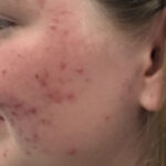 Acne Treatment Before & After Patient #11016