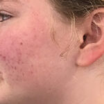Acne Treatment Before & After Patient #11016
