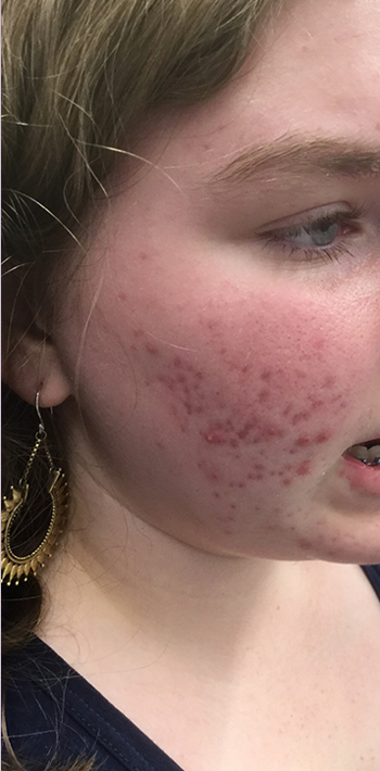 Acne Treatment Before & After Patient #11019
