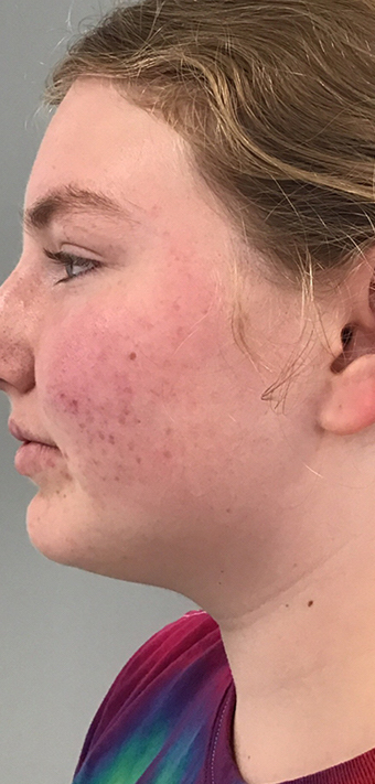 Acne Treatment Before & After Patient #11019