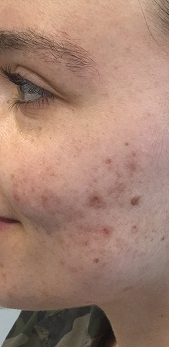 Acne Treatment Before & After Patient #11028