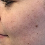 Acne Treatment Before & After Patient #11028