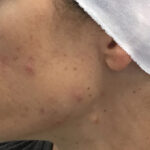 Acne Treatment Before & After Patient #11031