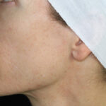 Acne Treatment Before & After Patient #11031
