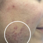 Acne Treatment Before & After Patient #11025