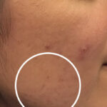 Acne Treatment Before & After Patient #11025