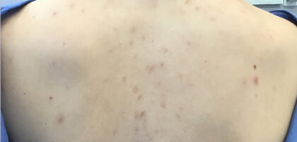 Acne Treatment Before & After Patient #11048