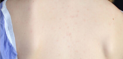 Acne Treatment Before & After Patient #11048