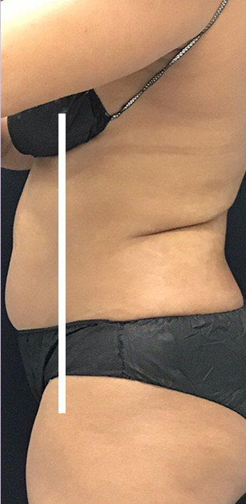 Abdominal Contouring Before & After Patient #11054