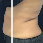 Abdominal Contouring Before & After Patient #11054