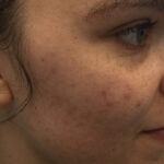 Acne Treatment Before & After Patient #11057