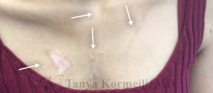 Scar Removal Before & After Patient #11013