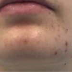 Acne Treatment Before & After Patient #11100
