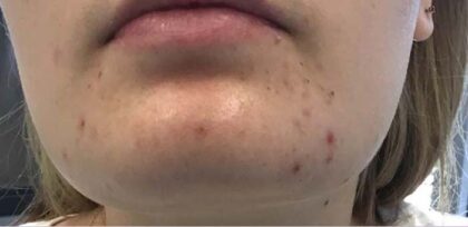 Acne Treatment Before & After Patient #11100