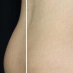 CoolSculpting Before & After Patient #11103