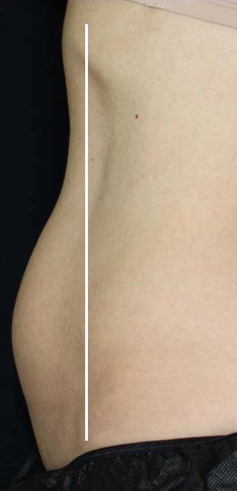 CoolSculpting Before & After Patient #11103