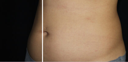 CoolSculpting Before & After Patient #11106