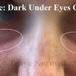 Dark Under Eyes Before & After Patient #11118