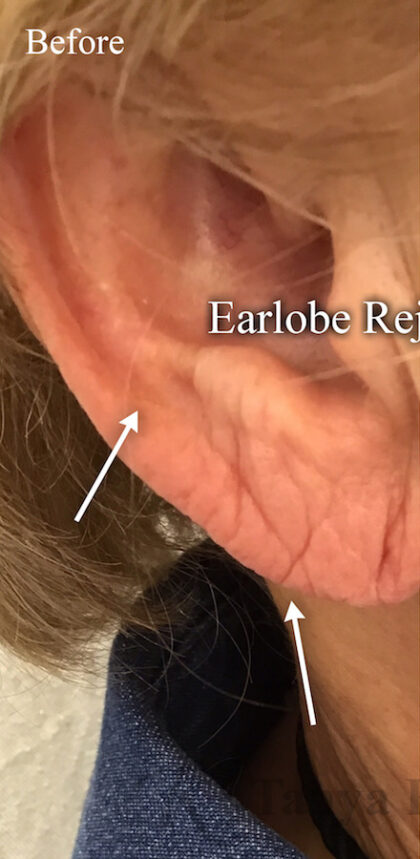 Earlobe Filler Before & After Patient #11132