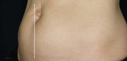 CoolSculpting Before & After Patient #11135