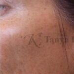 Fraxel Laser Therapy Before & After Patient #11153