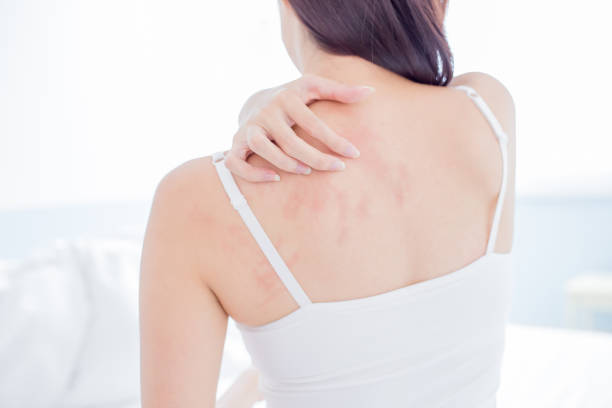 Skin Rash Treatment