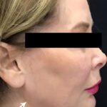 Jawline Contouring Before & After Patient #11159