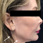 Jawline Contouring Before & After Patient #11159