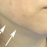 Jawline Contouring Before & After Patient #11165