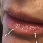 Juvederm Before & After Patient #11177