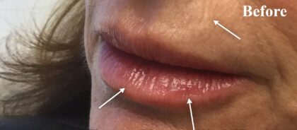 Juvederm Before & After Patient #11177