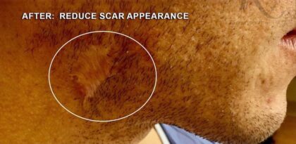 Scar Removal Before & After Patient #11178