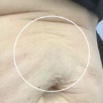 Stretch Marks Before & After Patient #11207
